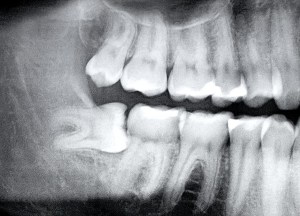 wisdom-teeth